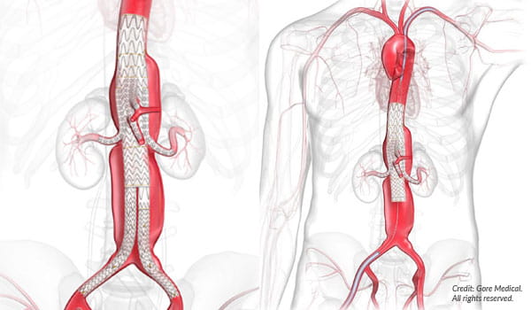 The TAMBE  procedure is light years ahead of traditional surgery for thoracoabdominal aortic aneurysms